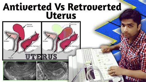 retroverted uterus in tagalog